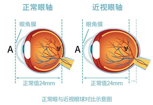 近视眼轴.jpg