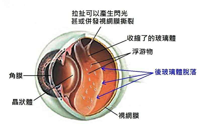 飞蚊症置之不理？警惕有可能是视网膜脱落的预警信号！