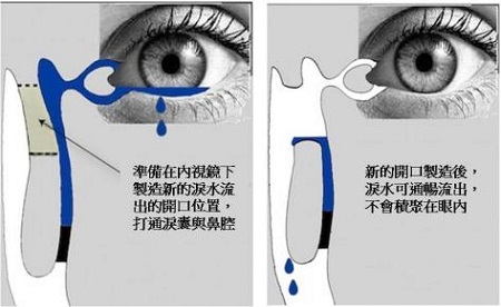 后天性的泪道阻塞