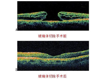 黄斑裂孔治疗