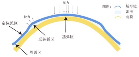 角膜塑形镜矫正近视