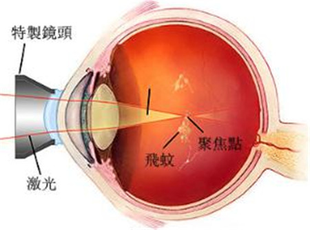 YAG激光玻璃体溶解术