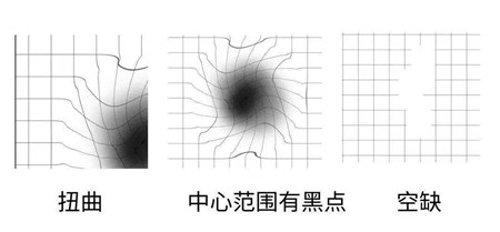 视物变形