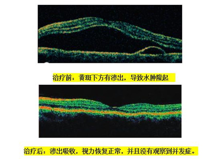 中浆如何治疗