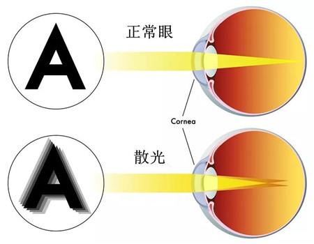 散光形成的原因