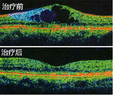 黄斑水肿治疗