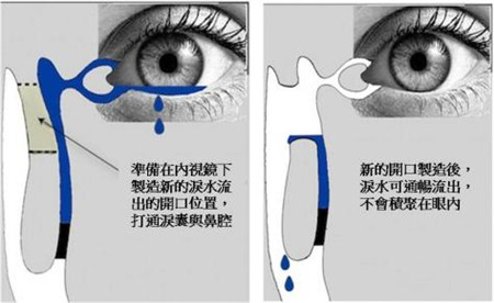 手术治疗先天性泪道阻塞