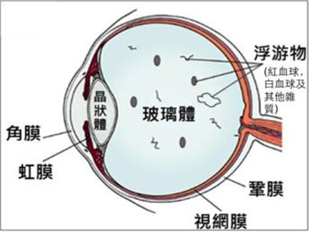 视网膜病变有哪些症状