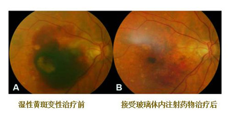 黄斑变性治疗