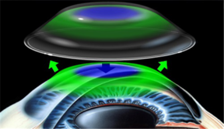 角膜塑形镜佩戴注意事项