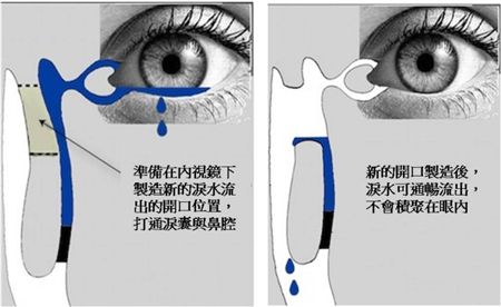 泪囊鼻腔吻合手术