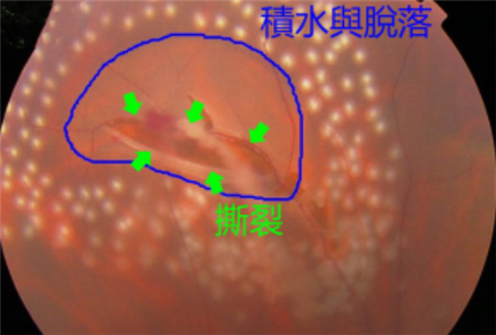 视网膜撕裂的原因