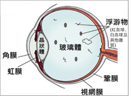 飞蚊症是如何形成的