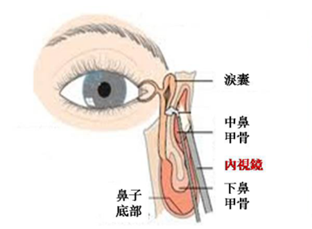 泪囊鼻腔吻合术