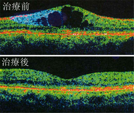 黄斑水肿治疗