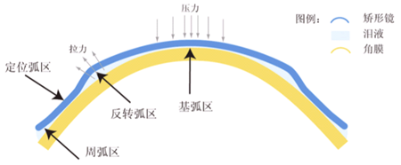 角膜塑形镜的原理