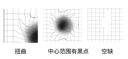 黄斑变性症状