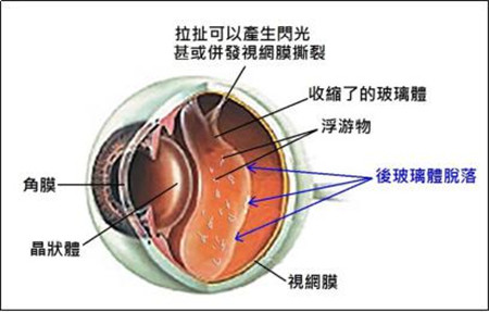 后玻璃体脱落