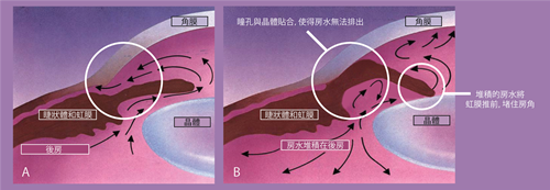 会导致严重受损的三大致盲性眼病你都知道吗？