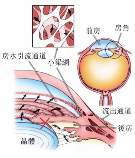 白内障和青光眼