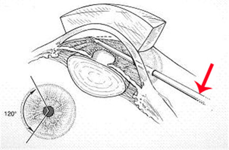 房角切开术