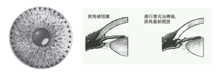 激光虹膜边缘成形手术