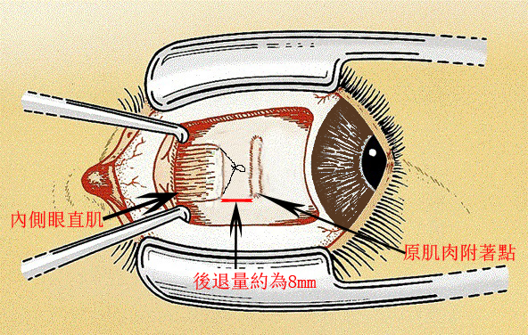 北京斜视手术哪家医院做得好？