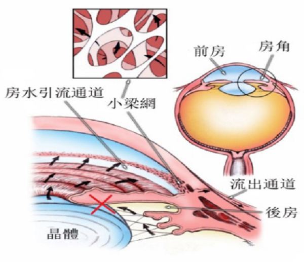 青光眼和白内障，这对难兄难弟是如何互相影响的?