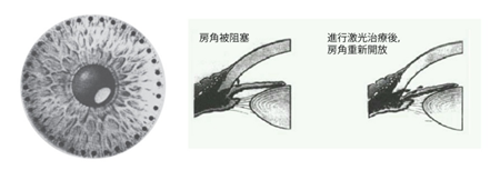 急性闭角型青光眼治疗