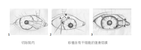 翼状胬肉手术切除