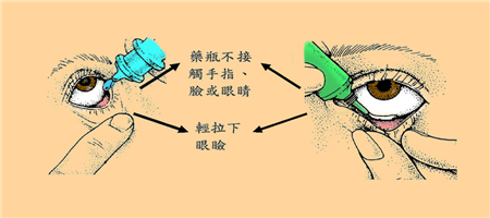 眼药水的正确滴法