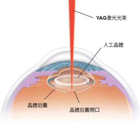 北京治疗后发性白内障