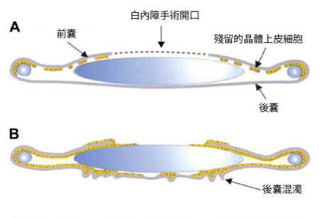 白内障术后复发怎么办