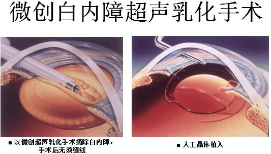 北京治疗白内障多少钱